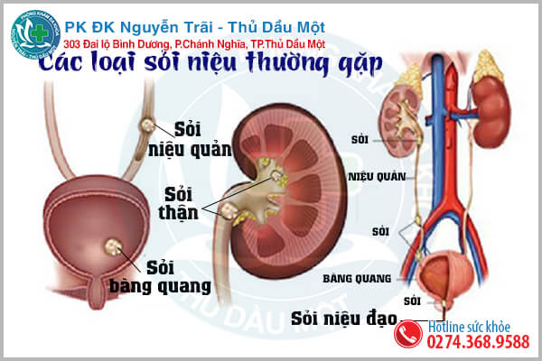 Sỏi niệu là bệnh gì?