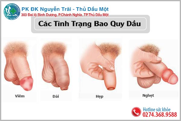 Những trường hợp nên cắt bao quy đầu