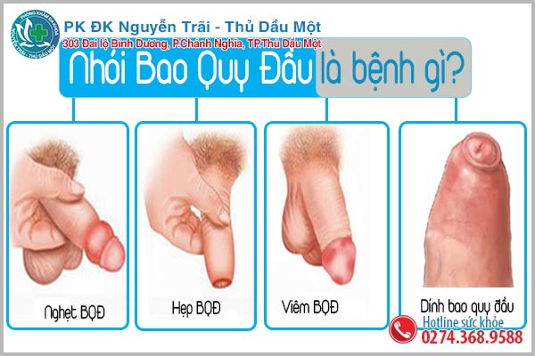 Nhói bao quy đầu là dấu hiệu của bệnh gì?