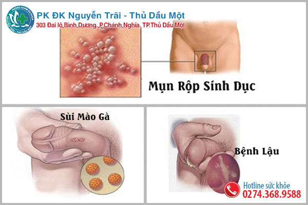 Quy đầu nổi mẫn đỏ có thể là dấu hiệu của bệnh xã hội