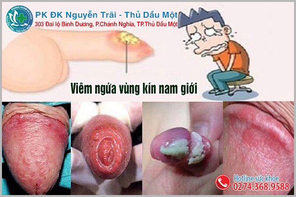 Viêm ngứa vùng kín nam giới cảnh báo mắc phải bệnh lý nguy hiểm