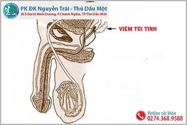 Nguyên nhân gây viêm túi tinh