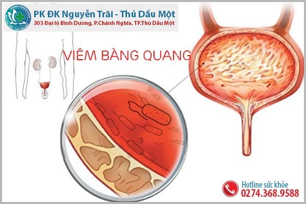 Đau bàng quang ở nam giới có phải bị viêm?