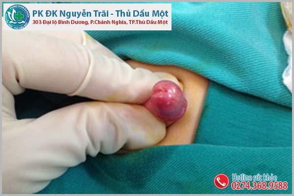 Dính bao quy đầu là tình trạng như thế nào?