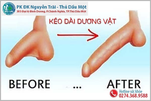 Kéo dài dương vật