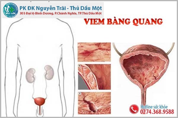 Viêm bàng quang ở nam giới