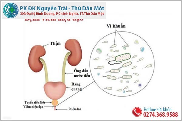 Dấu hiệu viêm niệu đạo phổ biến mà nam giới thường gặp